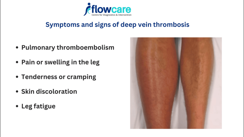 signs of dvt in leg
