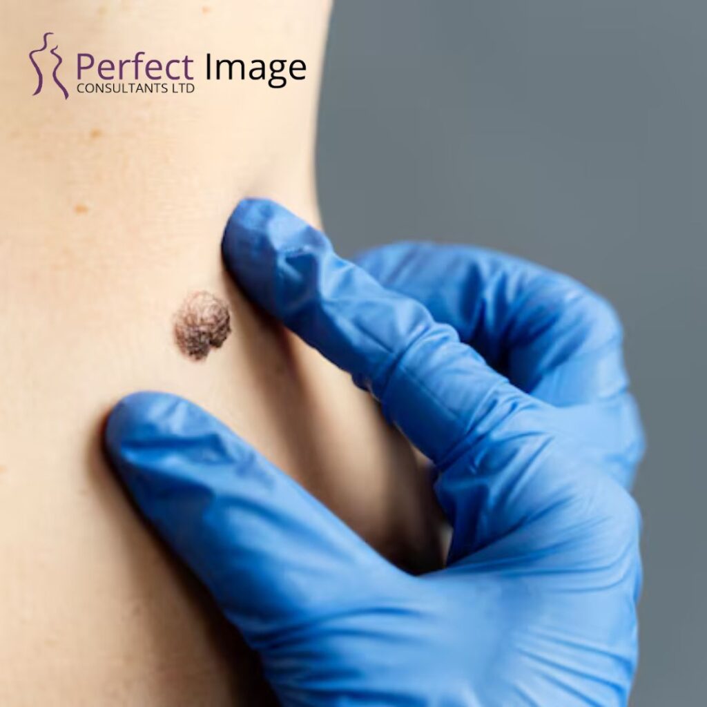 Cyst Removal