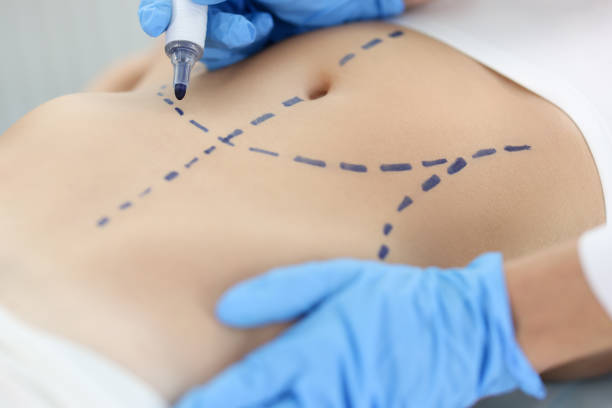 Liposuction surgery
