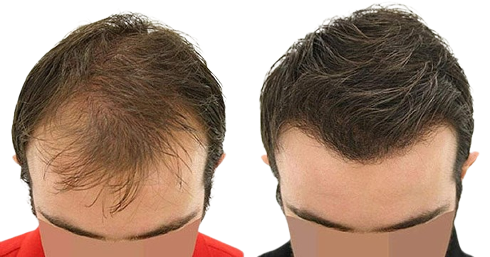 زراعة الشعر في دبي
