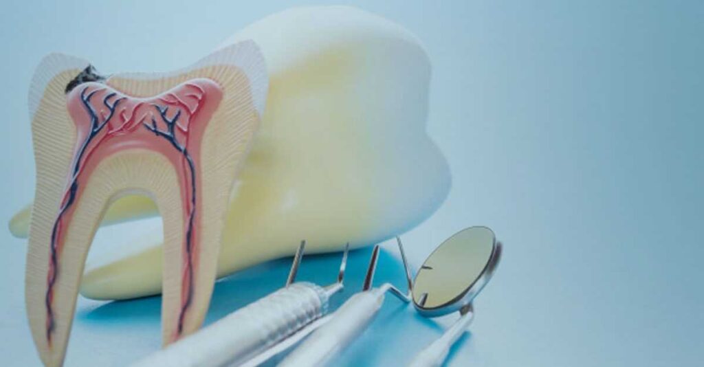 Root Canal Treatment in Islamabad