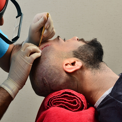 Hair transplant in Islamabad