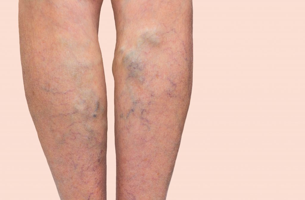 Advanced Laser Varicose Veins Treatment