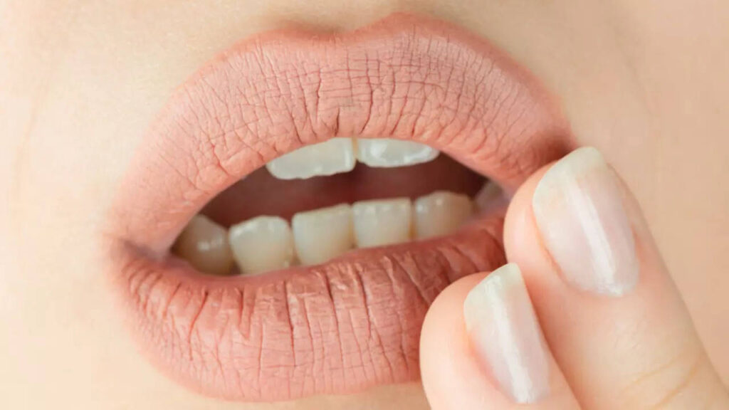 Does Smoker’s Lips Treatment Remove Deep Lip Lines?