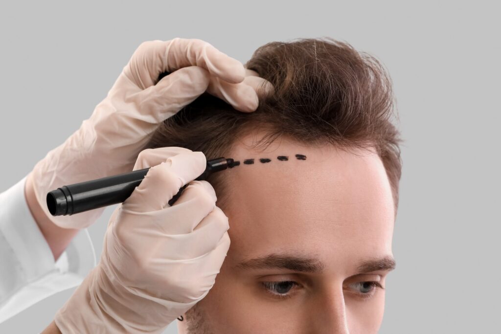 How FUE Hair Transplant Can Transform Your Appearance
