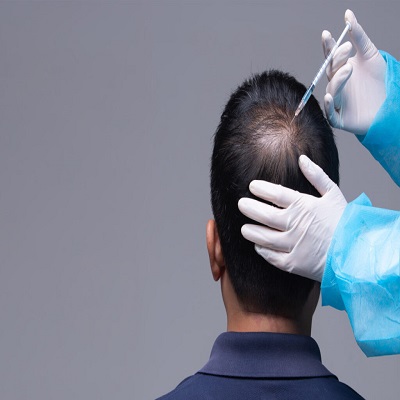 PRP hair treatment in islamabad