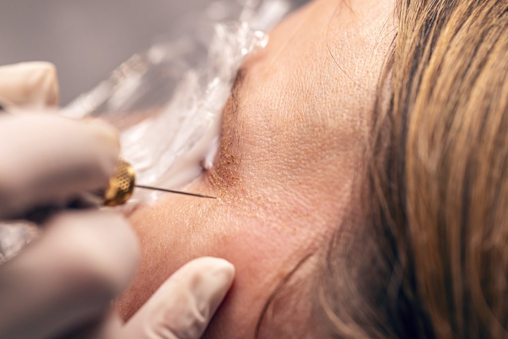 Plasma Pen Treatment Can Reduce Dark Spots and Pigmentation