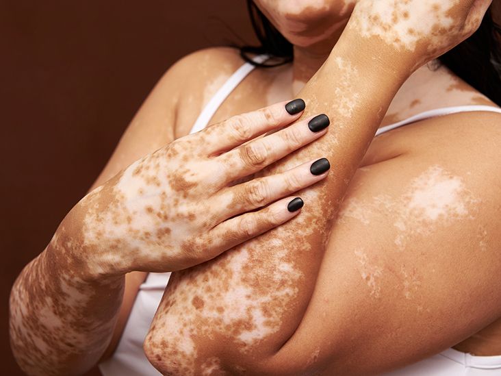What Are the Most Popular Vitiligo Treatment Techniques?