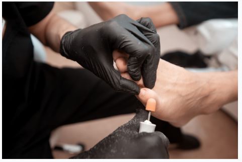 ingrown toenail