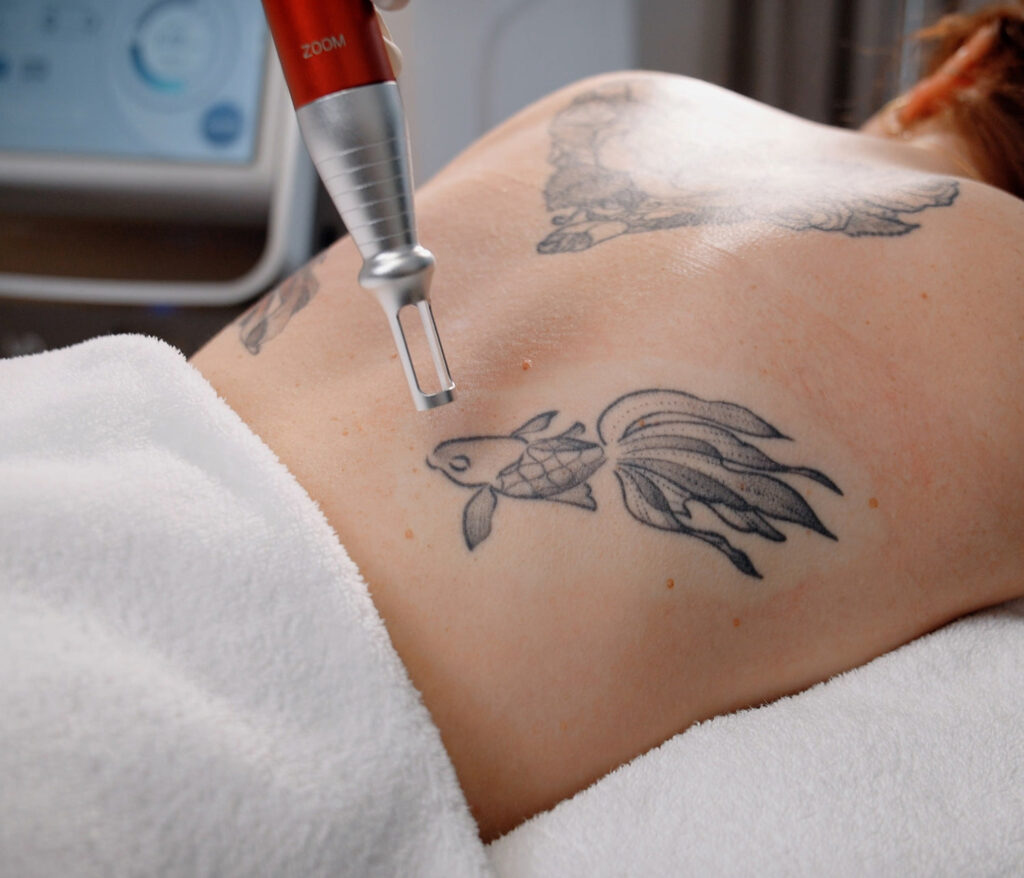 The Science Behind PicoSure Tattoo Removal