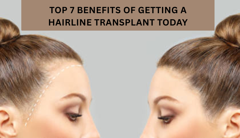 hairline transplant