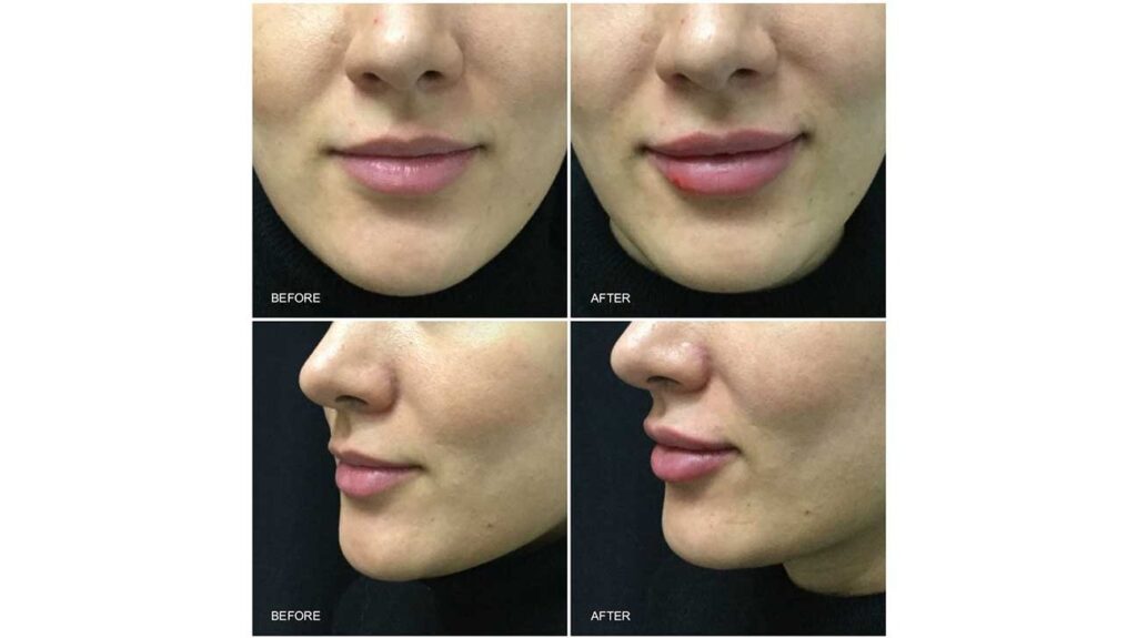 Juvederm Fillers in Dubai