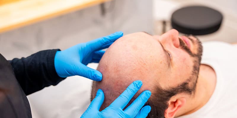Can You Afford a Hair Transplant
