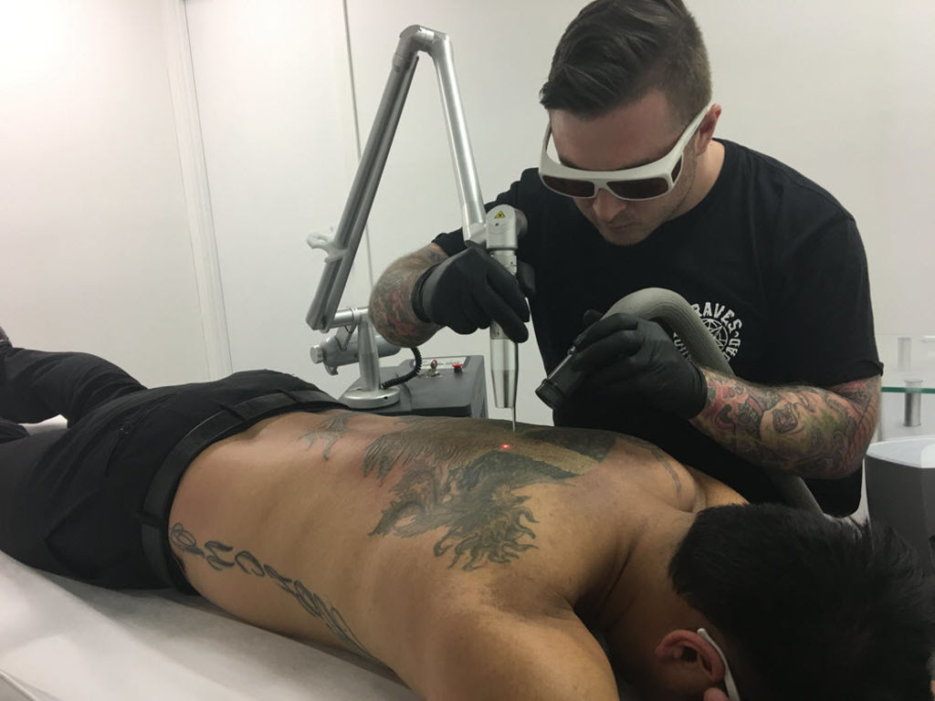 Comfortable and Effective Laser Tattoo Removal