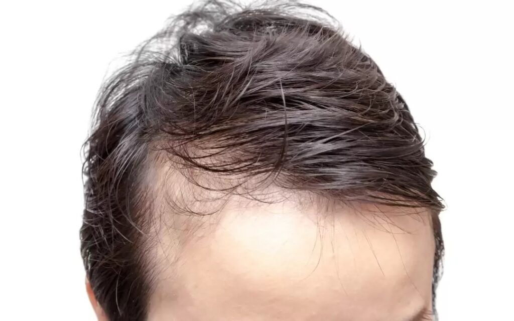 Front Line Hair Fixing in Dubai
