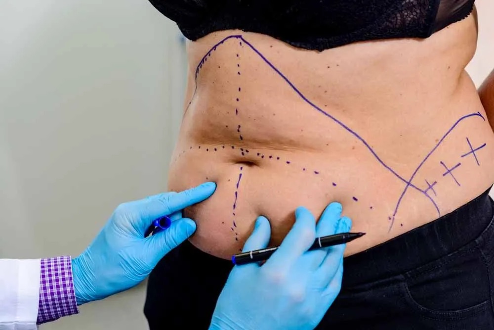 Lipo Abdominoplasty vs Traditional Tummy Tuck