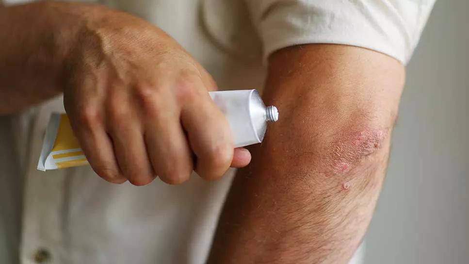 How Doctor Home Visit Helps with Severe Dermatitis