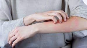 Scabies Prevention Tips Protect Yourself and Your Family