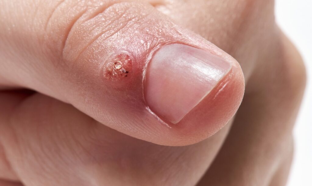 Skin Wart Removal Cost in Dubai