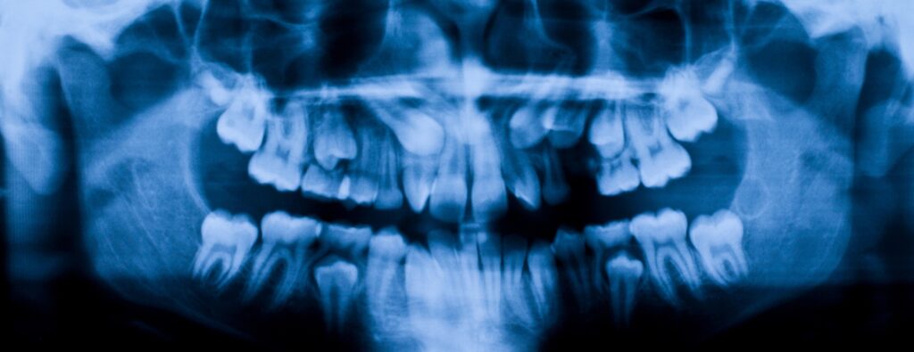 Panoramic Dental X-Ray Cost in Dubai