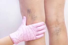 Varicose Vein Treatment in Pune