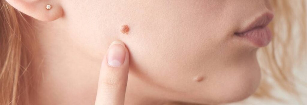 Skin Wart Removal Cost in Dubai