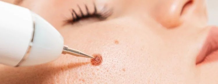 Skin Wart Removal Cost in Dubai
