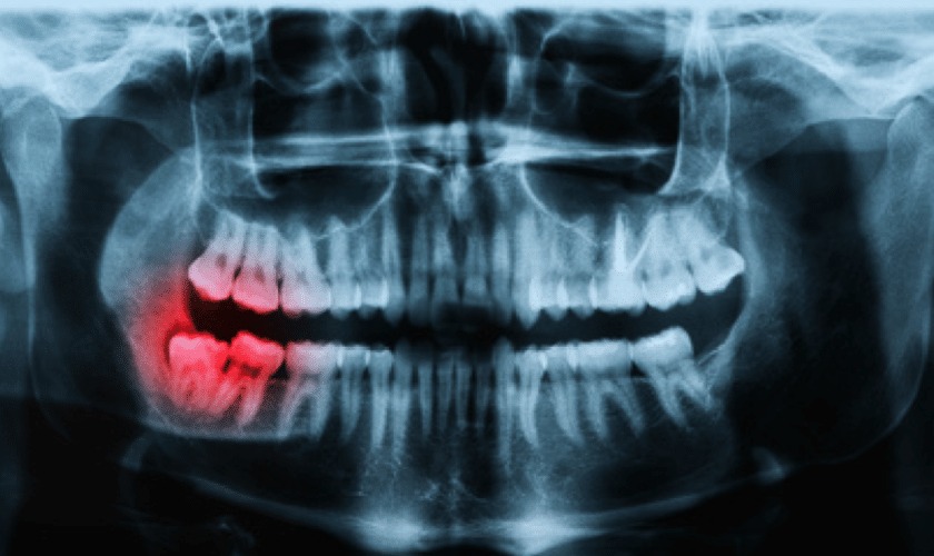 Panoramic Dental X-Ray Cost in Dubai