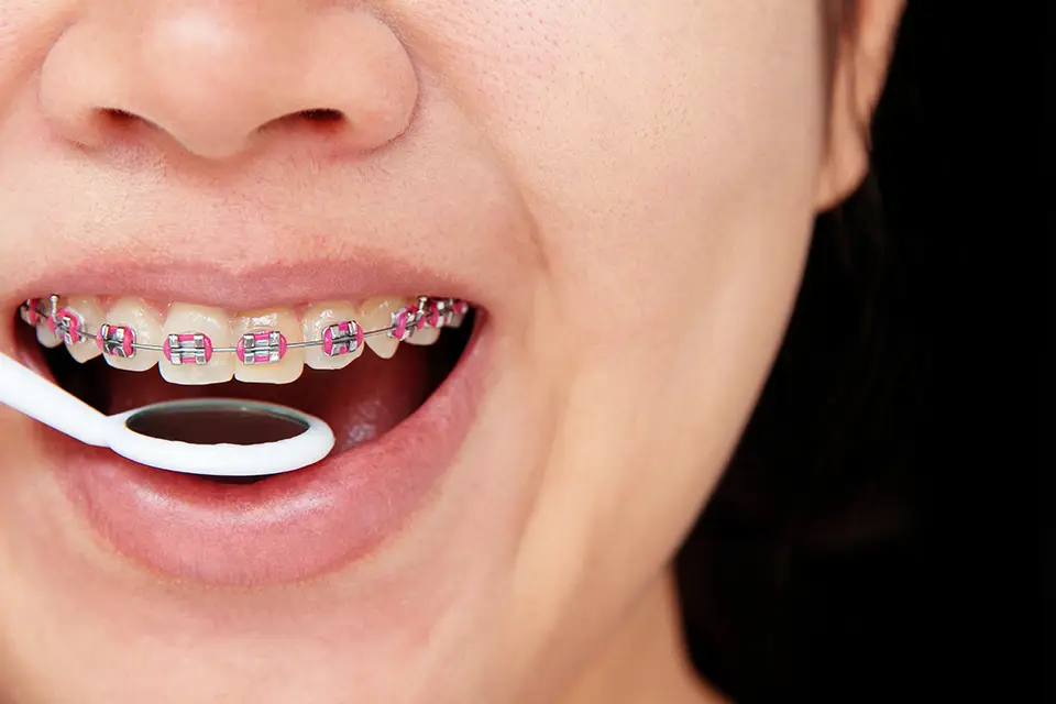 Common Myths About Dental Braces Debunked