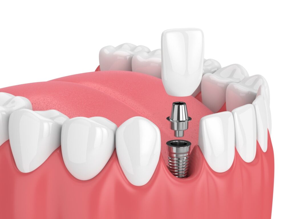 cheap tooth implant