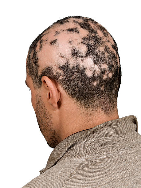 Does Age Impact Alopecia Areata Treatment Results