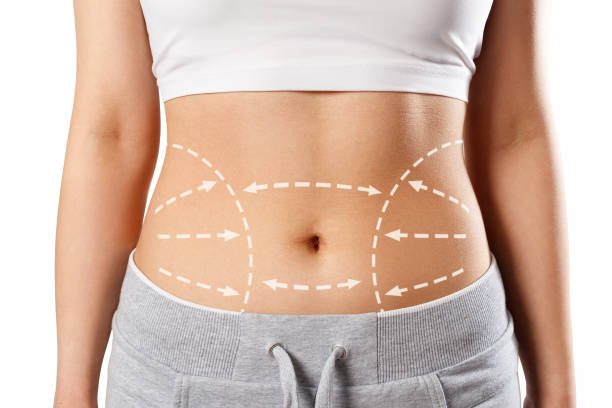 Does Liposuction Help with Cellulite Reduction Too