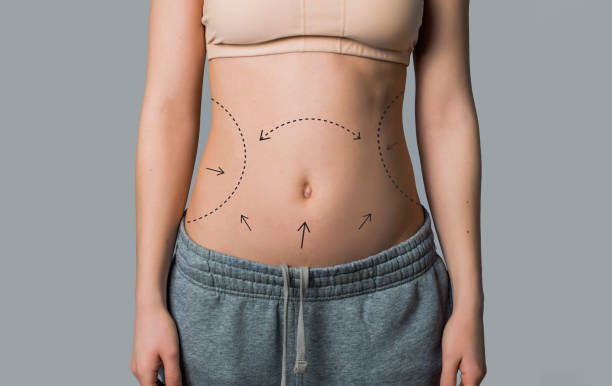 Does Liposuction Work for Small Areas?