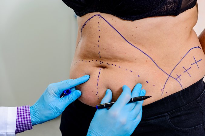 Everything You Need to Know About Fat Transfer Surgery