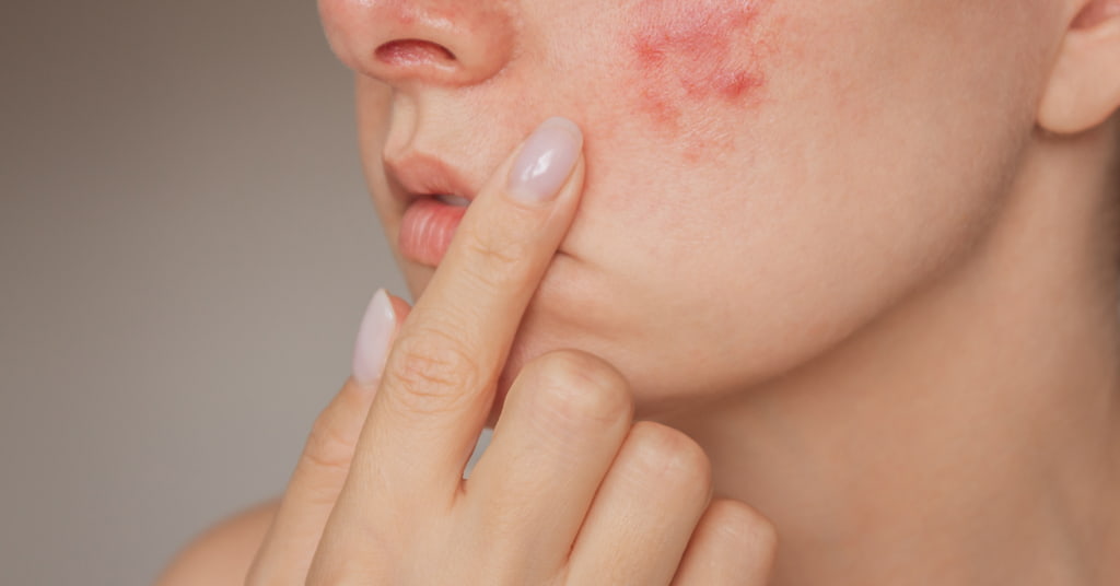 How Acne Treatment Fights Bacteria and Inflammation