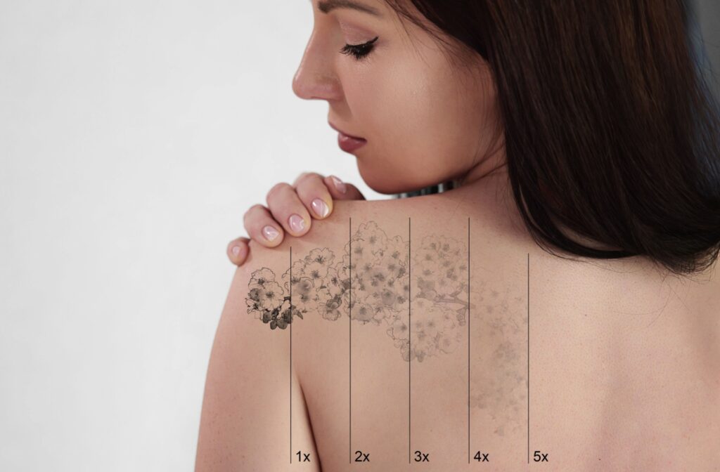 How Laser Tattoo Removal Deals with Stubborn Ink