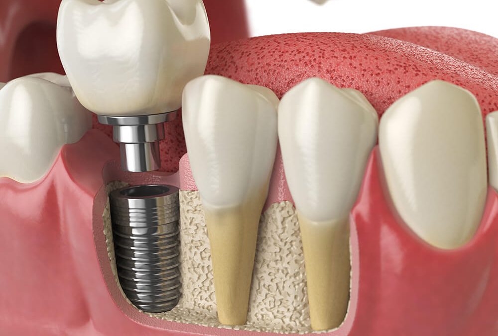 How Long Do Dental Implants Really Last