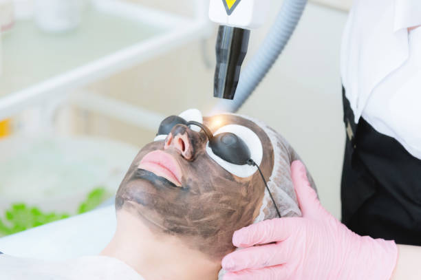 How Many Laser Carbon Peel Sessions Do You Need