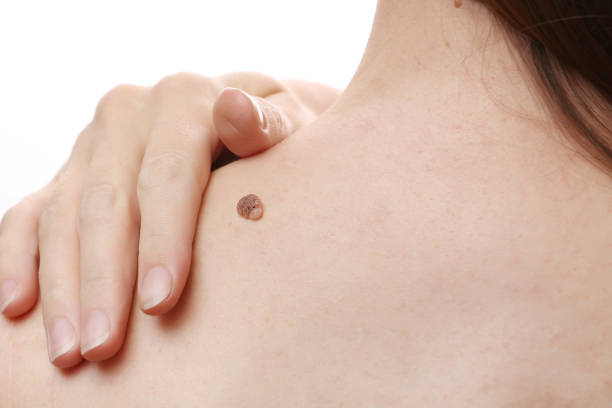 How to Prepare for Warts Removal Treatment Safely