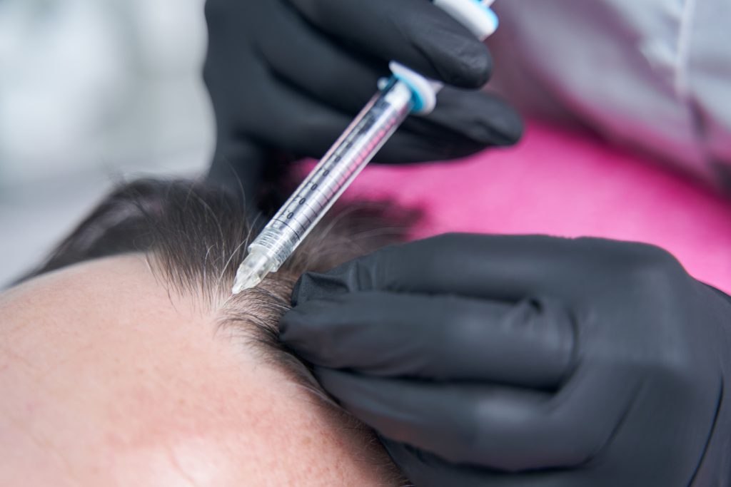 Natural Results from Stem Cell Hair Transplant