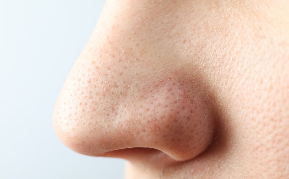 Rhinoplasty Subtle Enhancements for a Beautiful Profile