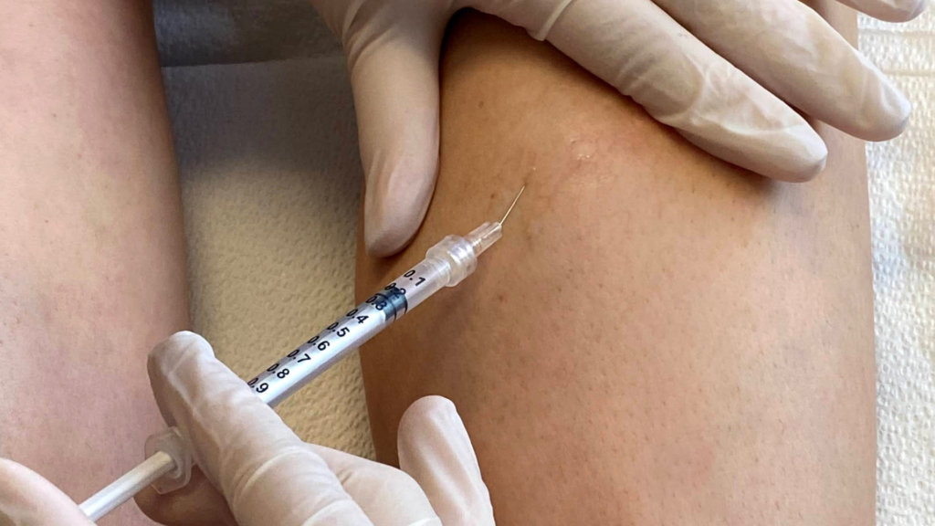 Say Goodbye to Vein Discomfort with Sclerotherapy