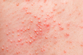Skin Rashes