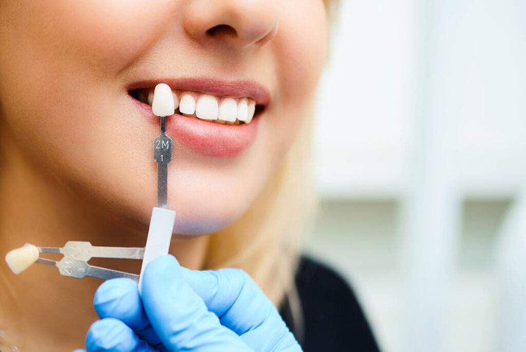Smile Makeovers with E-Max Veneers