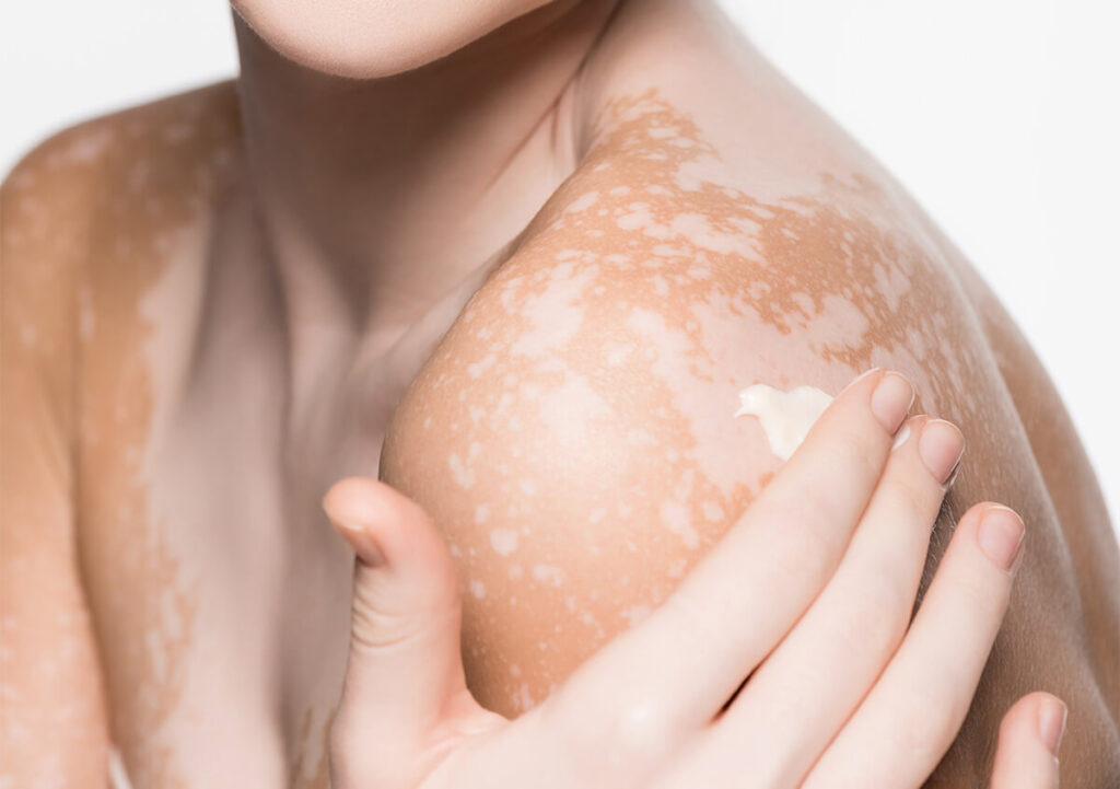 Stable Vitiligo Best Treatment Paths