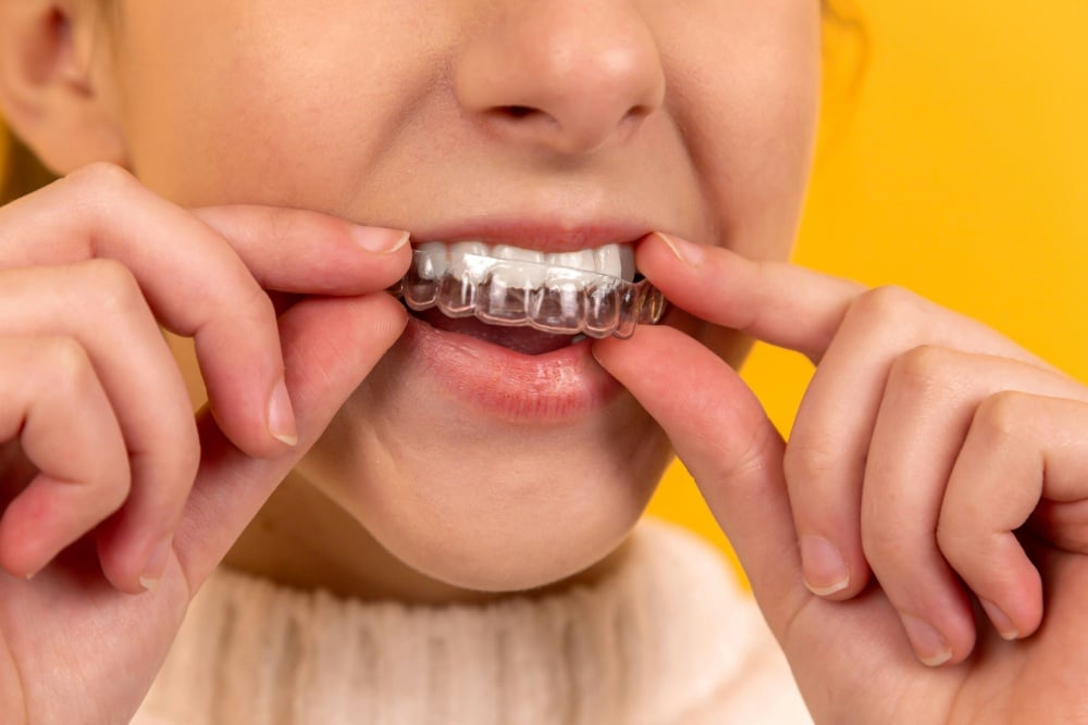 Step by Step Journey of Getting Aligners Explained