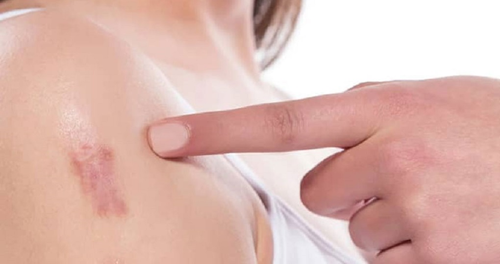 Surgical Scar Revision Smooth, Scar-Free Skin