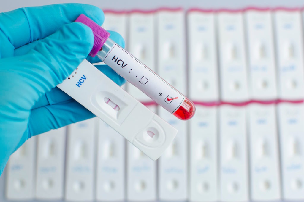 Hepatitis C Test in Dubai