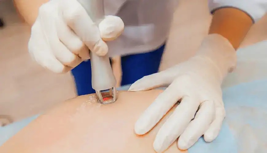 Laser Stretch Marks Treatment in Dubai