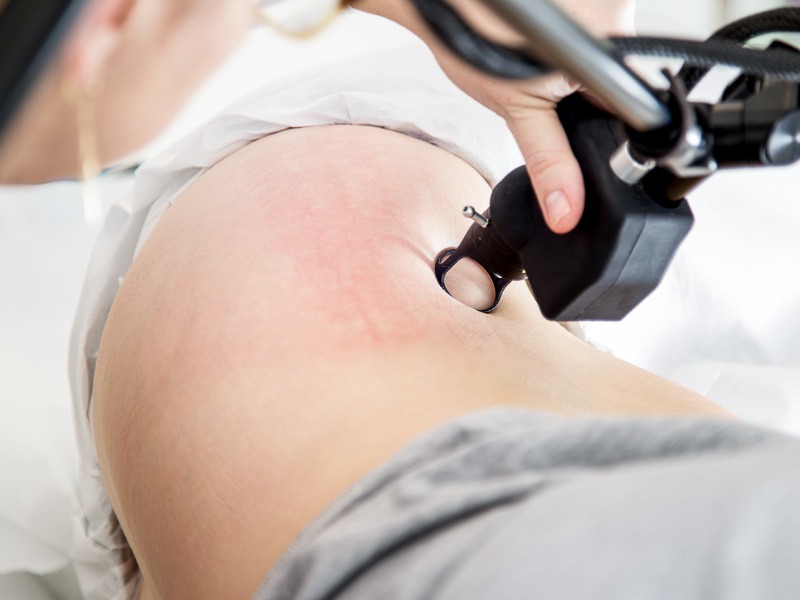 Laser Stretch Marks Treatment